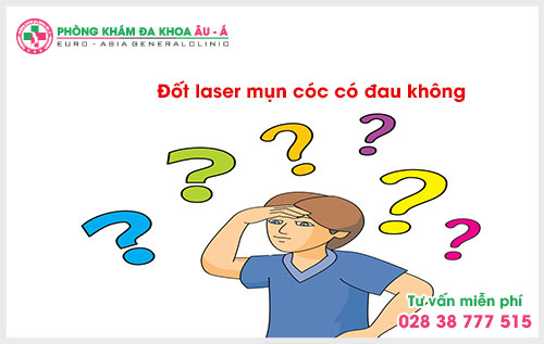  Đốt laser mụn cóc có đau không?