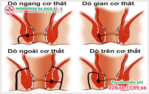  Mổ rò hậu môn ở đâu tốt  trên khu vực TP.HCM