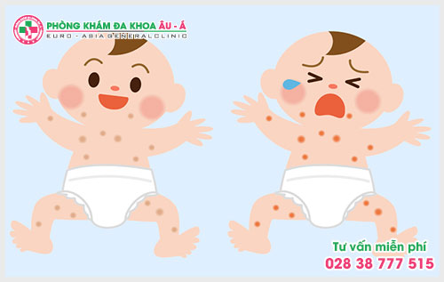  Tìm hiểu về bệnh chàm sữa trước khi quá muộn