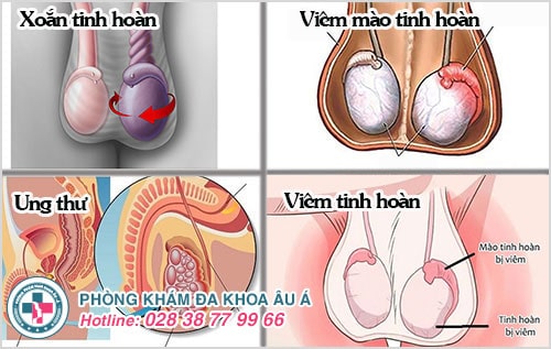 bệnh tinh hoàn bệnh tinh hoàn