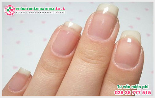  Đề phòng với những dấu hiệu của bệnh vảy nến móng tay