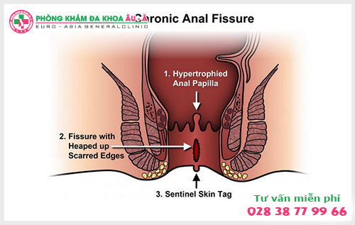  Điều trị rò hậu môn ở đâu hiệu quả  tại TPHCM?
