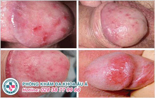 Top các bệnh viêm nhiễm nam khoa thường gặp Top các bệnh viêm nhiễm nam khoa thường gặp