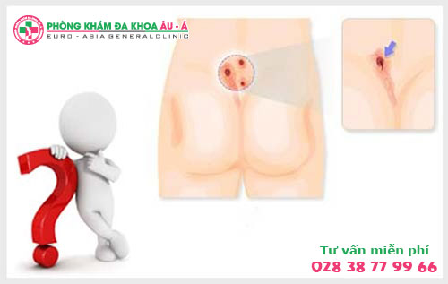  Lở loét hậu môn là do đâu?