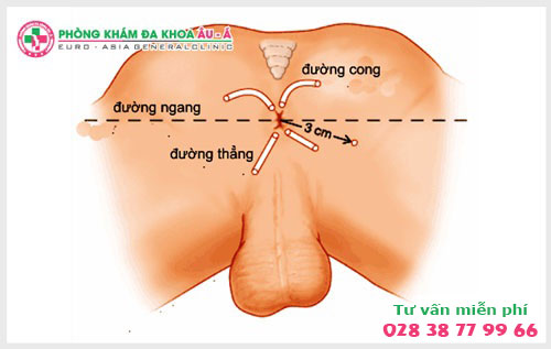  Phương pháp hỗ trợ điều trị rò hậu môn hiệu quả