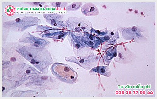  Nguy Hại Và Phương Pháp Điều Trị Bệnh Nấm Candida