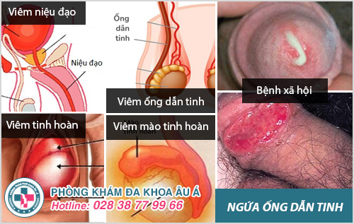 Ngứa ống dẫn tinh là bị bệnh gì? Điều trị như thế nào?