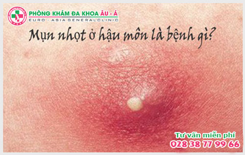  Triệu chứng nhọt hậu môn cảnh báo bệnh lý nguy hiểm gì?