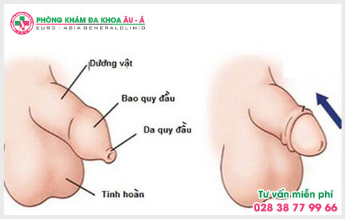  Như thế nào là bao quy đầu bình thường và bạn có biết về các bệnh bao quy đầu?