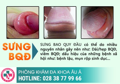  Đầu Dương Vật Bị Đỏ Là Bệnh Gì? Cách Điều Trị Như Nào?