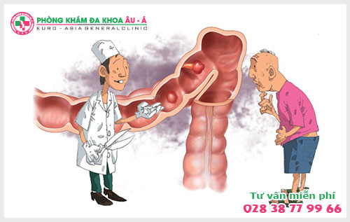  Cắt polyp hậu môn: lựa chọn phương pháp phù hợp