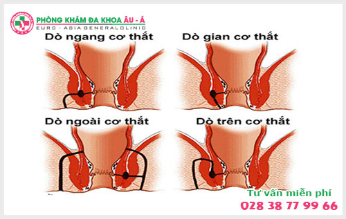  7 Nguyên nhân dẫn đến bệnh rò hậu môn bạn nên biết
