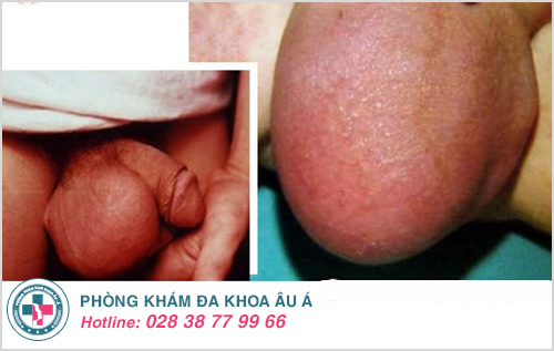 thuốc chữa viêm tinh hoàn thuốc chữa viêm tinh hoàn