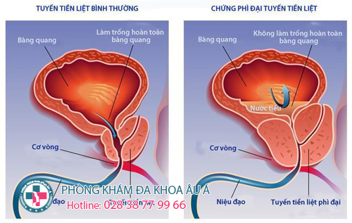  Tiểu đêm nhiều lần ở nam giới có nguy hiểm không?