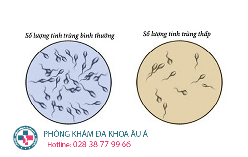  Tinh trùng ít có bị vô sinh không?