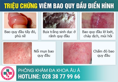  Bao Quy Đầu Nổi Mẩn Đỏ: Hình Ảnh, Tác Hại Và Chữa Ở Đâu?