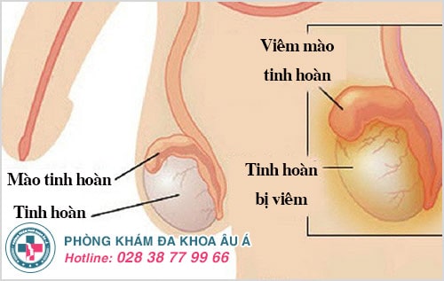 viêm mào tinh hoàn viêm mào tinh hoàn