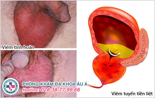 Top các bệnh viêm nhiễm nam khoa thường gặp Top các bệnh viêm nhiễm nam khoa thường gặp